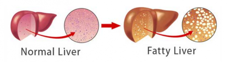 A Common Disease That Nobody's Heard Of 1 fatty liver vs normal liver