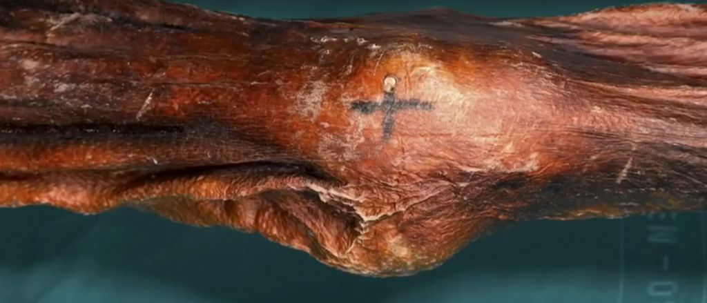 5300-Year-Old Mummy Practiced Acupressure 2 marking