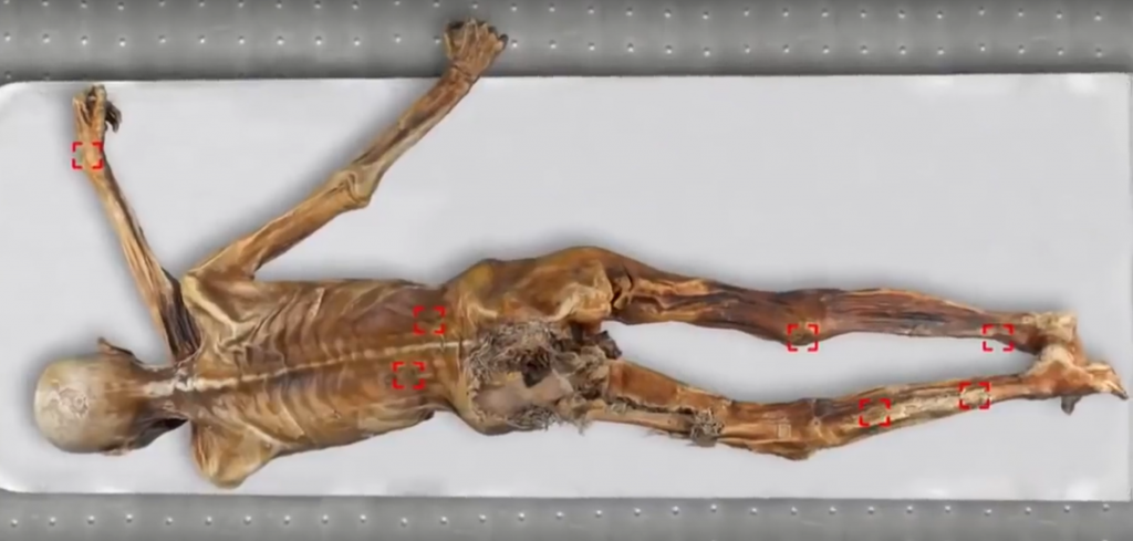 5300-Year-Old Mummy Practiced Acupressure 1 markings