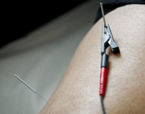 electroacupuncture electroacupuncture